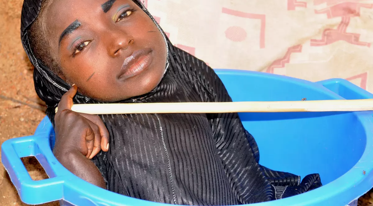 Trăiește doar într-un lighean! Viața crudă a unei tinere care suferă de o maladie rară