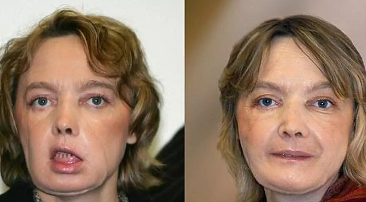 Isabelle Dinoire, prima femeie care a făcut transplant de față, a murit