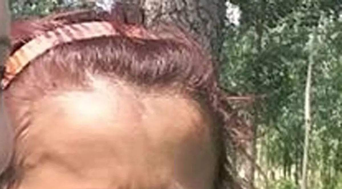 O femeie din Vaslui figurează cu transplantul la rinichi făcut, deși se află pe lista de așteptare din 2002