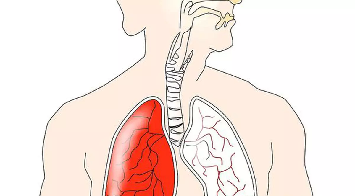 Cancerul la plămâni (cancerul pulmonar)