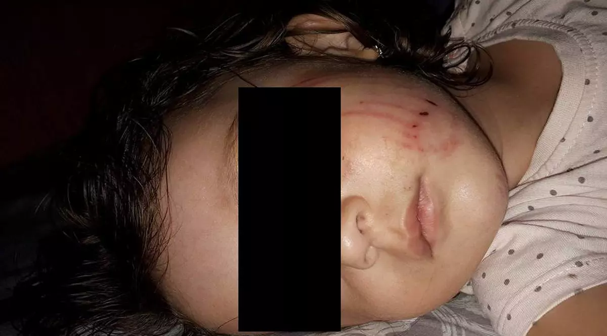 Fetiță atacată de un câine la Buzău