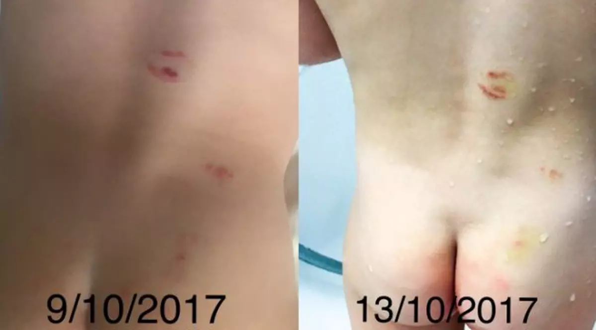 Caz şocant la o grădiniţă din Arad. Părinții unui copil acuză că cel mic a fost mușcat pe tot corpul