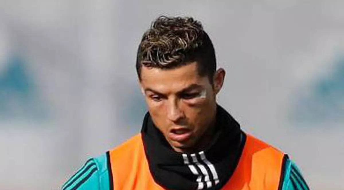 Cum arată fața lui Cristiano Ronaldo după accidentare / VIDEO