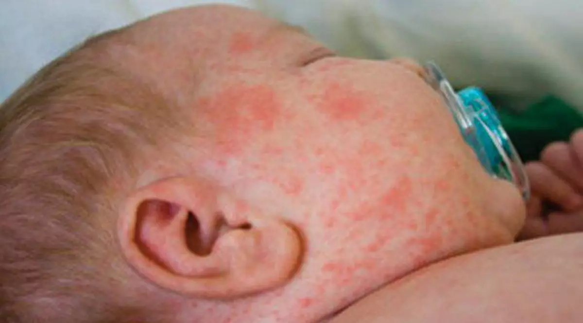 Epidemia de rujeola, de neoprit. Alte 208 cazuri noi