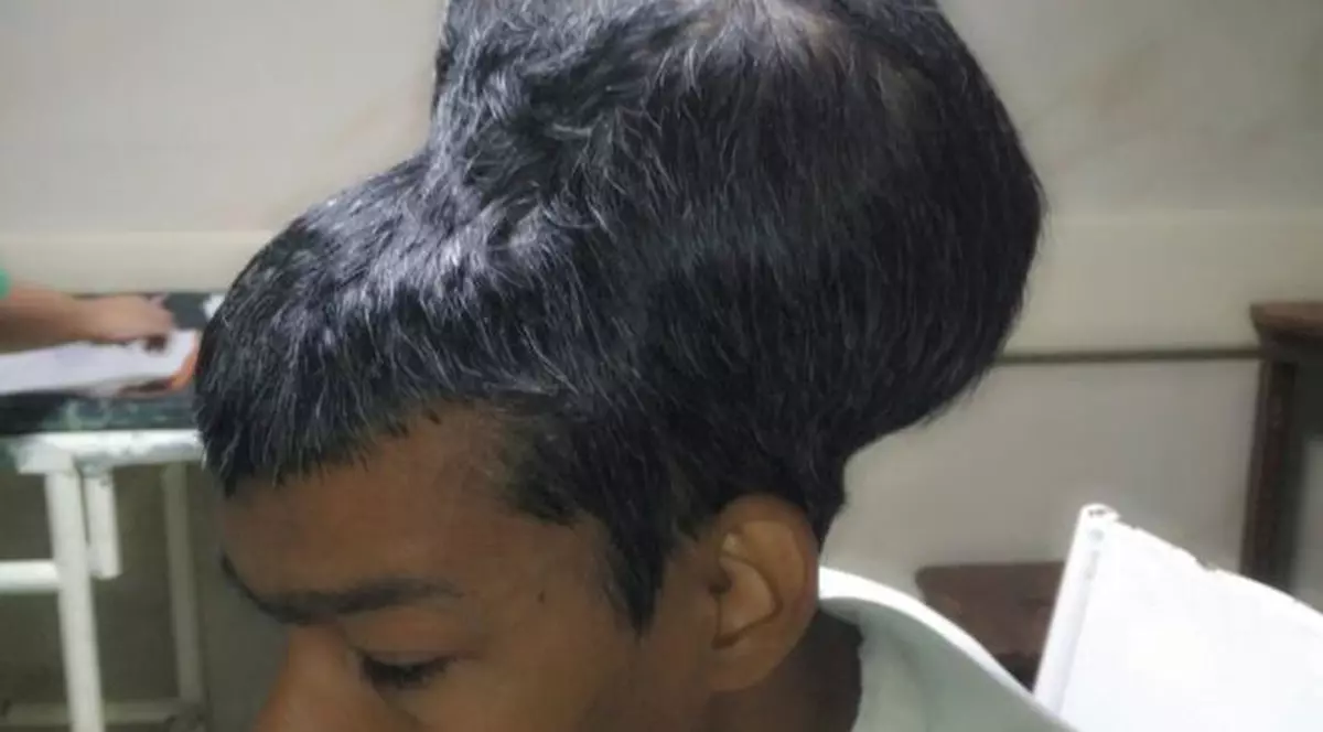 Medicii au înlăturat cea mai mare tumoare cerebrală din istorie