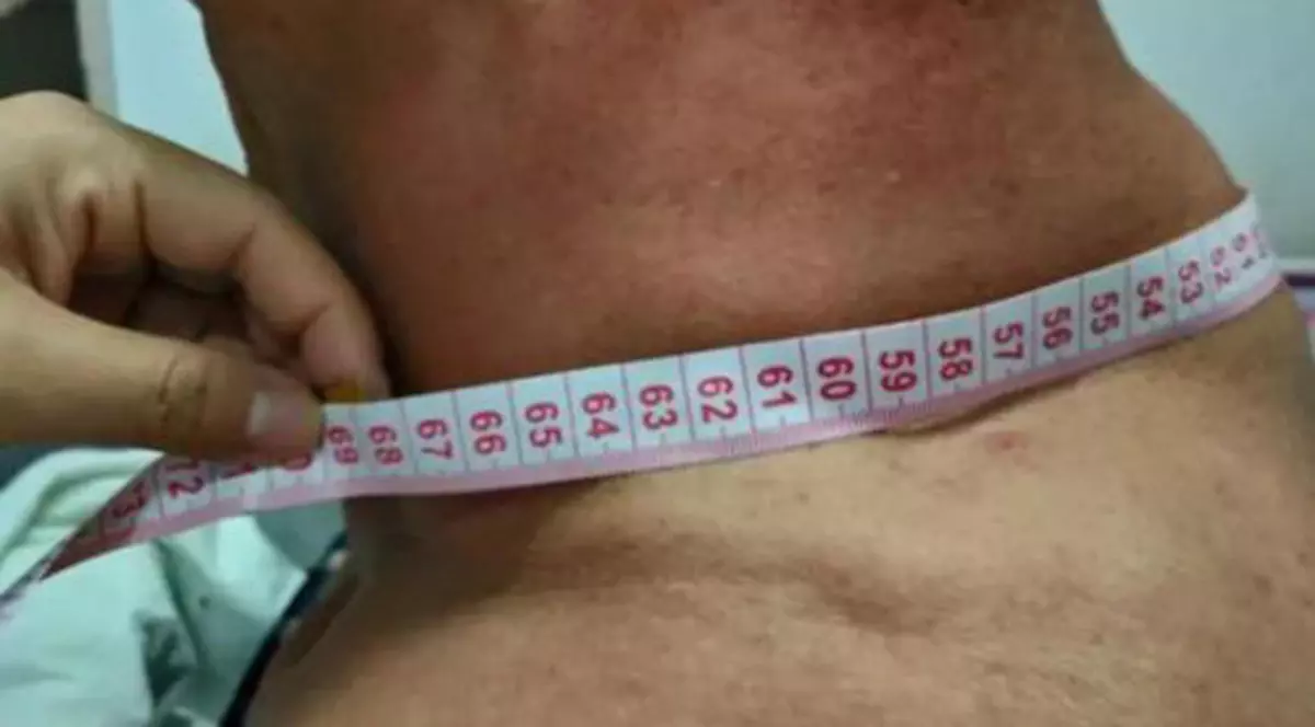 FOTO | Cum arată "Hulk", un pensionar care a consumat alcool în fiecare zi, timp de 30 de ani