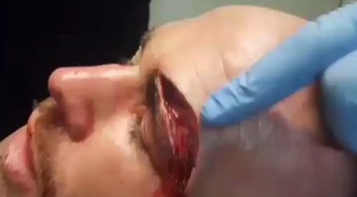 Cea mai oribilă accidentare din sport. Așa arăta Jack Mason, după un meci de MMA