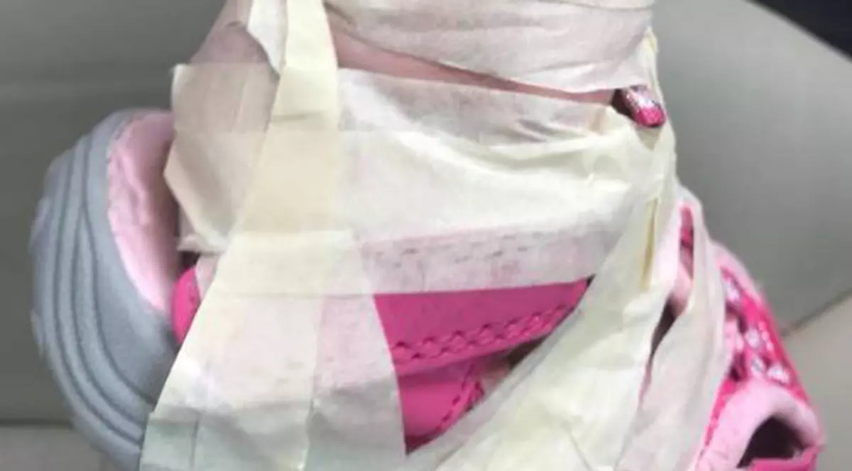 FOTO | Angajații unei creșe i-au lipit unei fetițe pantofii de picioare lăsând-o plină de răni