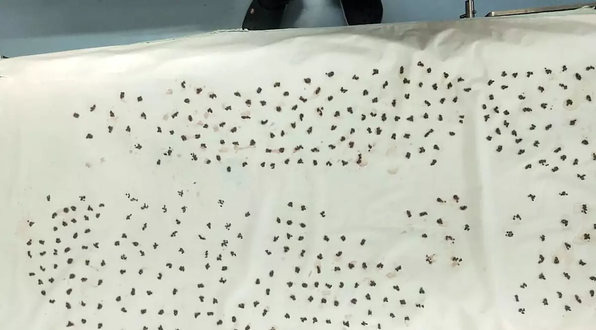 Doctorii indieni au reușit să scoată 4.100 de pietre din vezica biliară a unui bărbat