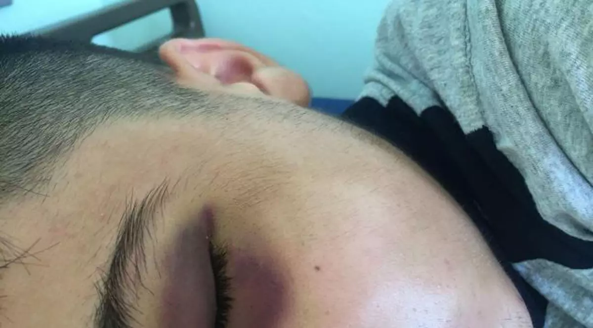 Elev din Craiova, bătut de un adolescent care practică boxul. Imagine cu adolescentul plin de vânătăi