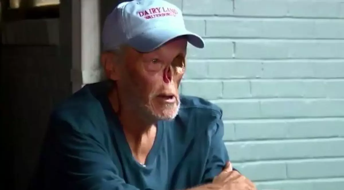 Un bărbat desfigurat de cancer a fost dat afară dintr-un magazin