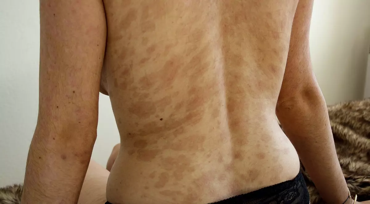 Fotografii cu puternic impact emoțional! Un medicament banal pentru amigdalită a desfigurat-o și i-a provocat arsuri groaznice pe 90 la sută din piele! Mărturiile cutremurătoare ale victimei