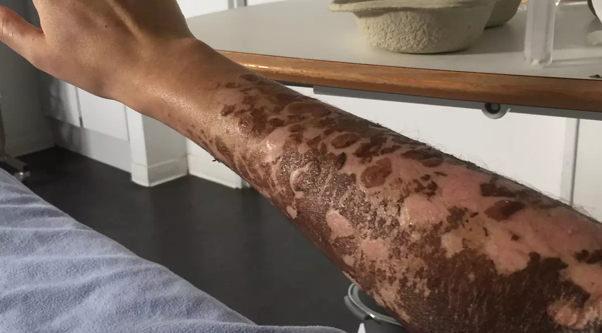 O femeie cu arsuri grave nu poate fi tratată la București, pentru că nu mai sunt locuri. Ce soluție s-a găsit