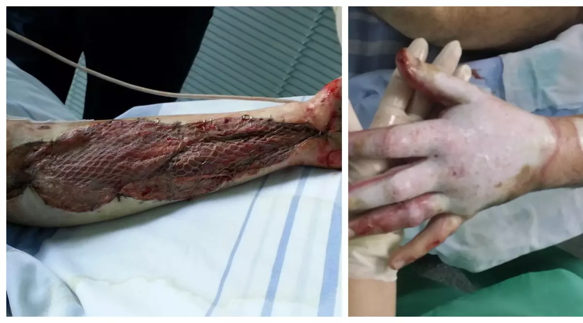 SECRETELE "COLECTIV": În timp ce marii arși au fost lăsați acasă, în primul avion a fost îmbarcat un ziarist fără răni grave, afectat doar pe mâini, cu recomandarea ”continuarea tratamentului și kinetoterapie”!