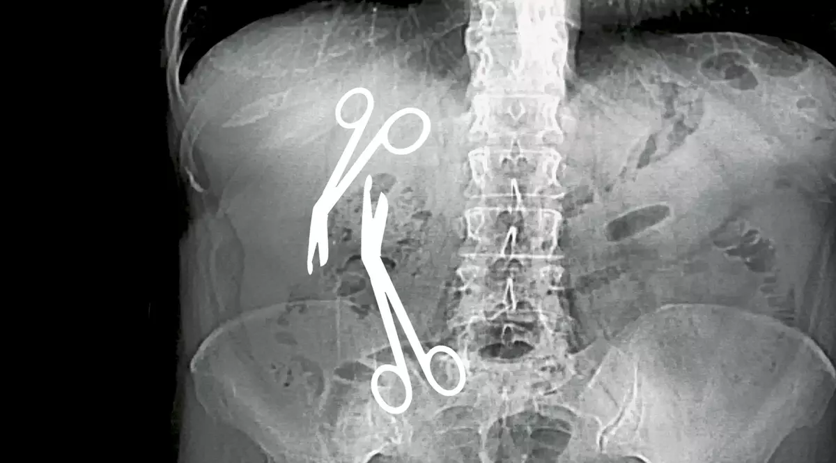 INVESTIGAȚIE EXCLUSIVĂ/ Directorul medical al Spitalului Militar din Constanța a uitat două foarfeci de 16 cm în burta unei paciente de 61 de ani!