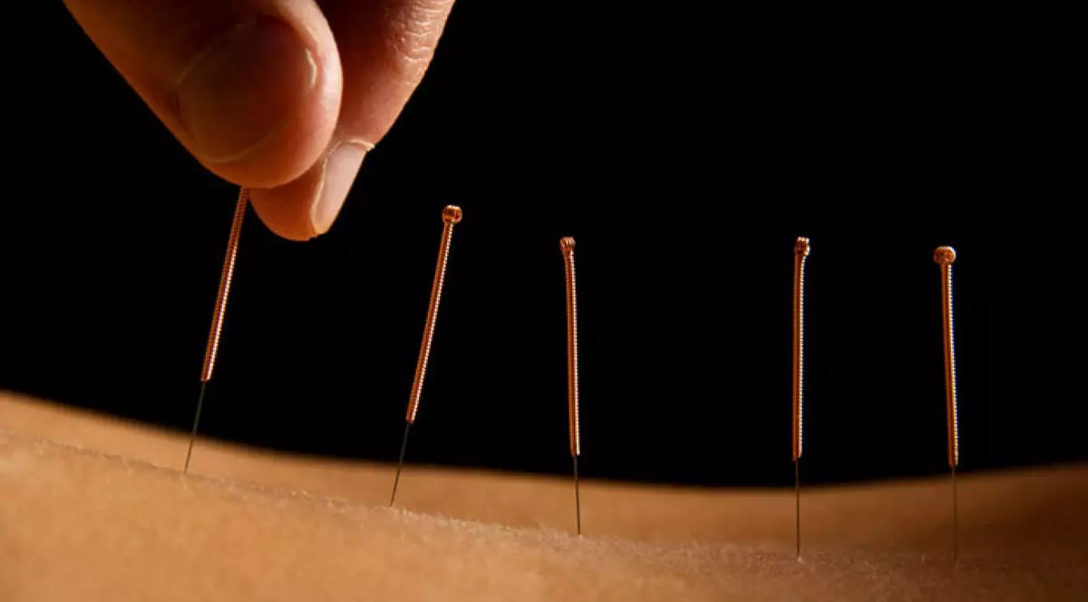 (P) Ce afecțiuni pot fi tratate într-un cabinet de acupunctură ?