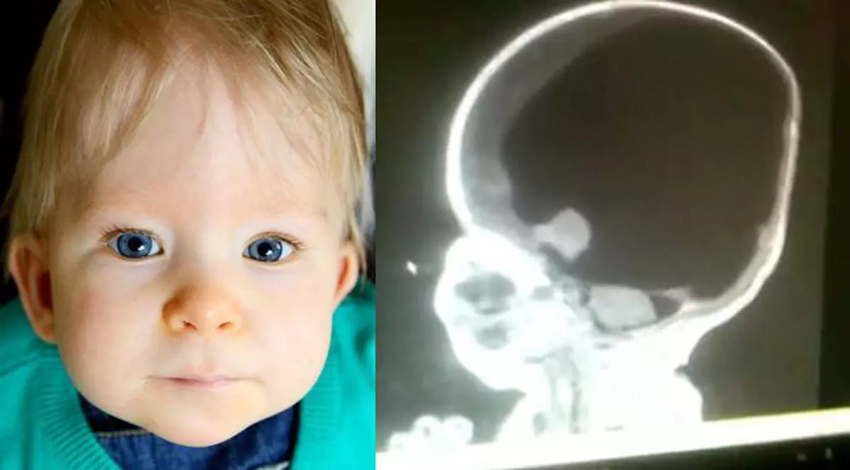 FOTO | Povestea incredibilă a băiețelului care s-a născut fără creier. Este uimitor ce a ajuns să facă la șase ani!