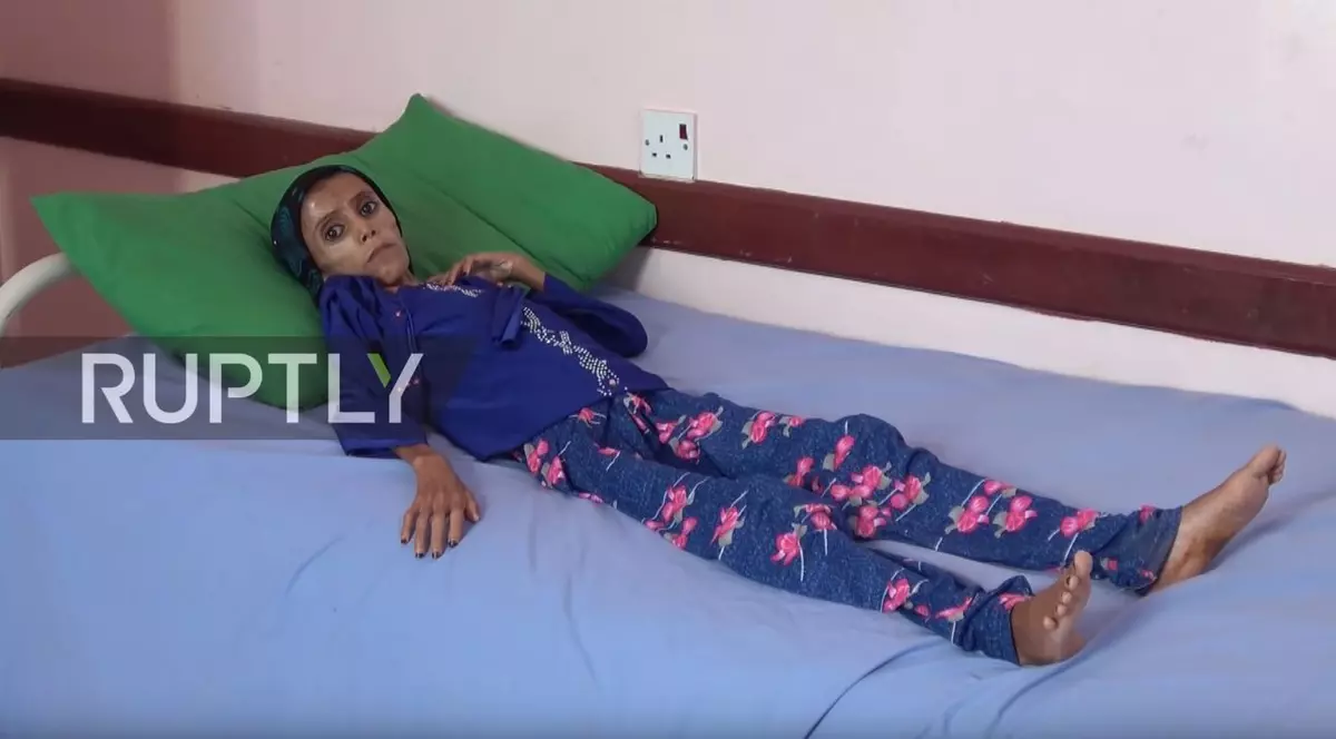 O fetiță din Yemen cântărește 10 kilograme, la 12 ani,