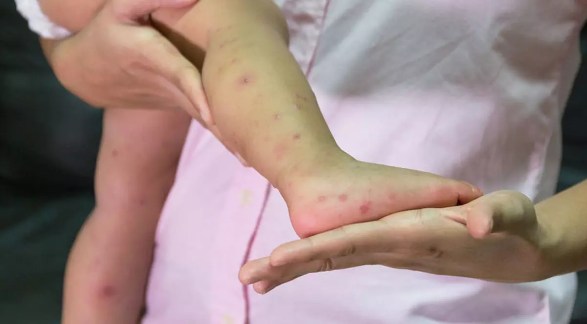 Alte 71 de cazuri noi de rujeolă, în ultima săptămână. În total, sunt 16.211 de cazuri