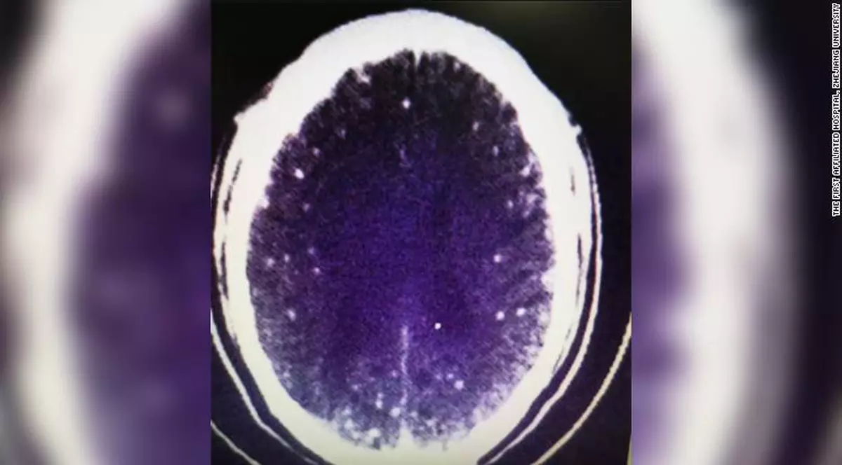 Un bărbat a început să aibă convulsii tot mai dese. Când a ajuns la spital, doctorii au rămas uimiți de ce au găsit în creierul respectivului