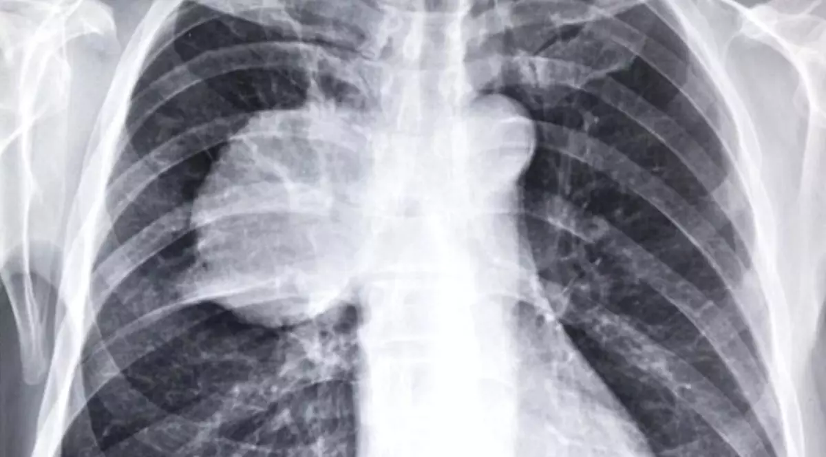 Un copil moare la fiecare 39 de secunde din cauza pneumoniei, la nivel mondial