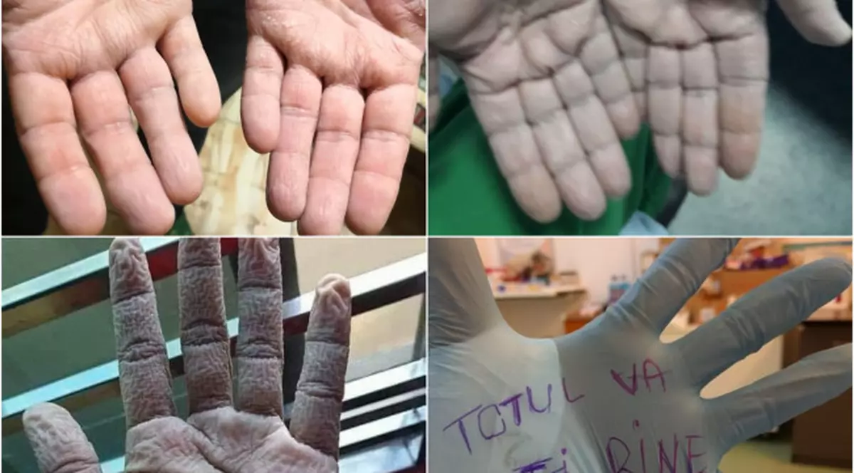 Imagini tulburătoare. Cum arată mâinile medicilor îmbrăcați în echipament anti COVID-19 ore în șir