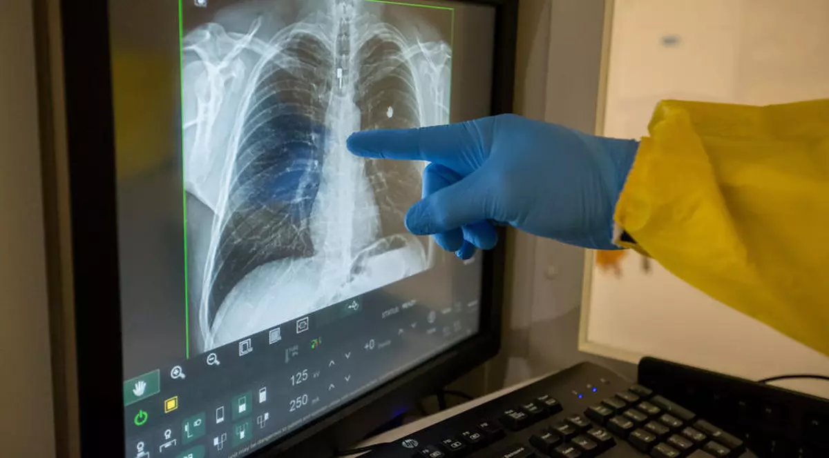 FOTO | Un chirurg din Texas spune că plămânii post-COVID arată mai rău decât ai celor mai înrăiți fumători