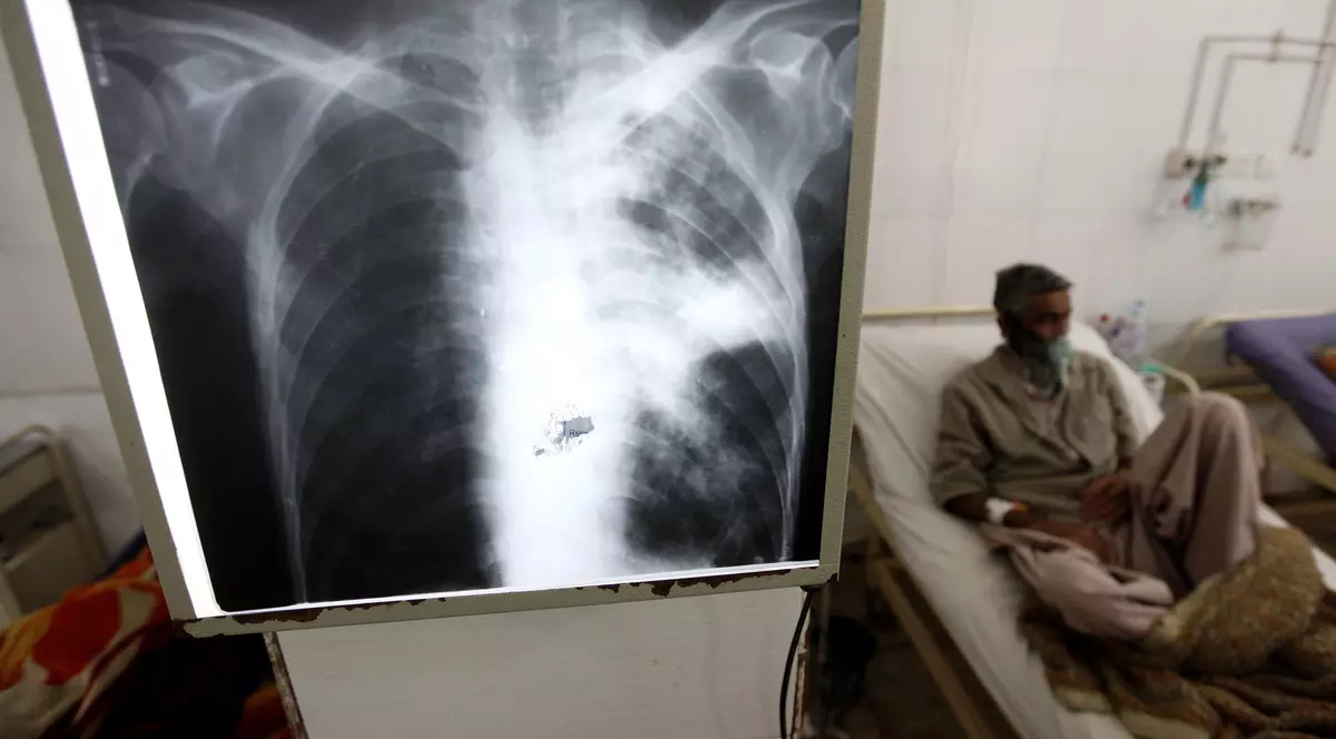 După cancere nediagnosticate, o altă scădere a avut loc pentru că oamenii au evitat spitalele în pandemie: cu 35% mai puțini pacienți descoperiți cu TBC