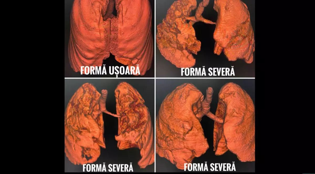 Cum modifică infecția cu coronavirus plămânii pacienților nevaccinați. Patru tomografii, publicate de CNCAV