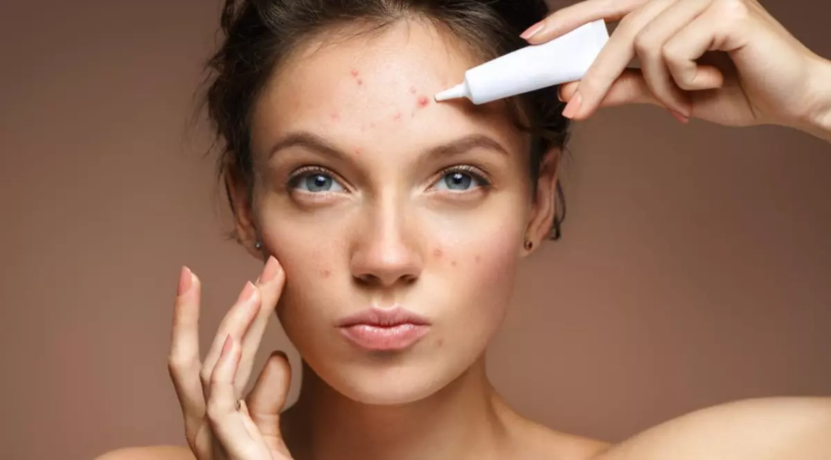 Cauzele mai puțin știute ale acneei la femei