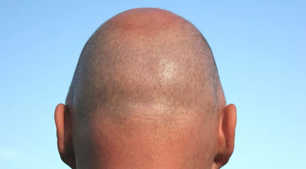 Remarcile privind chelia unui bărbat constituie hărțuire sexuală, potrivit unui tribunal britanic