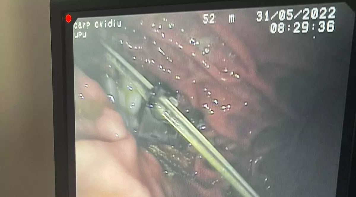 Trei piuneze, un cui, două agrafe, jumătate de balama, o brățară și alte obiecte, toate în stomacul unui bărbat din Suceava