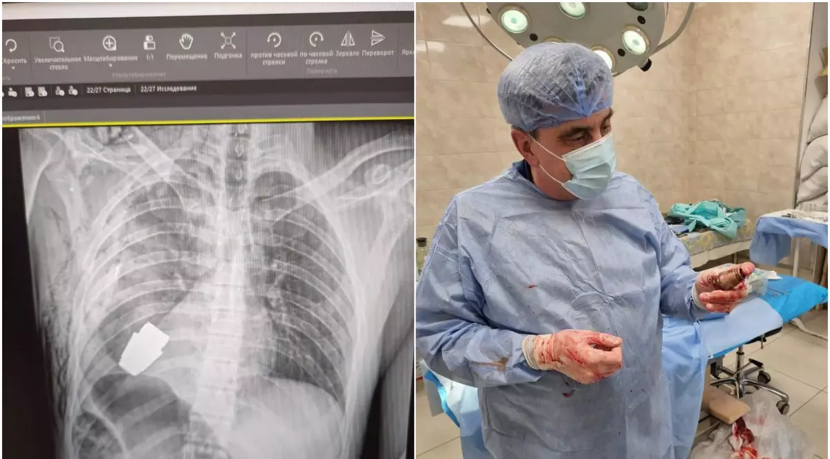 Un soldat ucrainean care avea în corp o grenadă neexplodată a fost operat cu succes de medicii militari