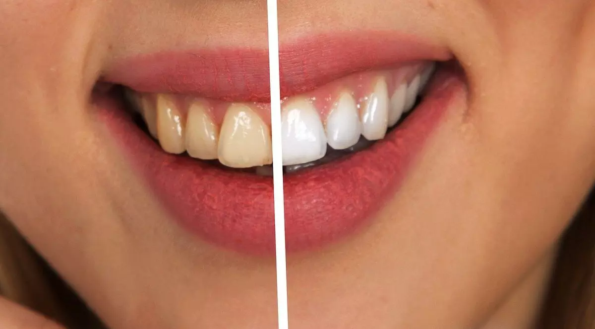 Este sigură albirea dinților acasă?