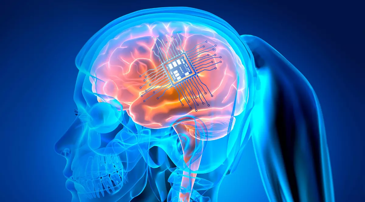 Medicii i-au scos implantul cerebral împotriva voinței sale. „Aș fi dat orice să-l păstrez”