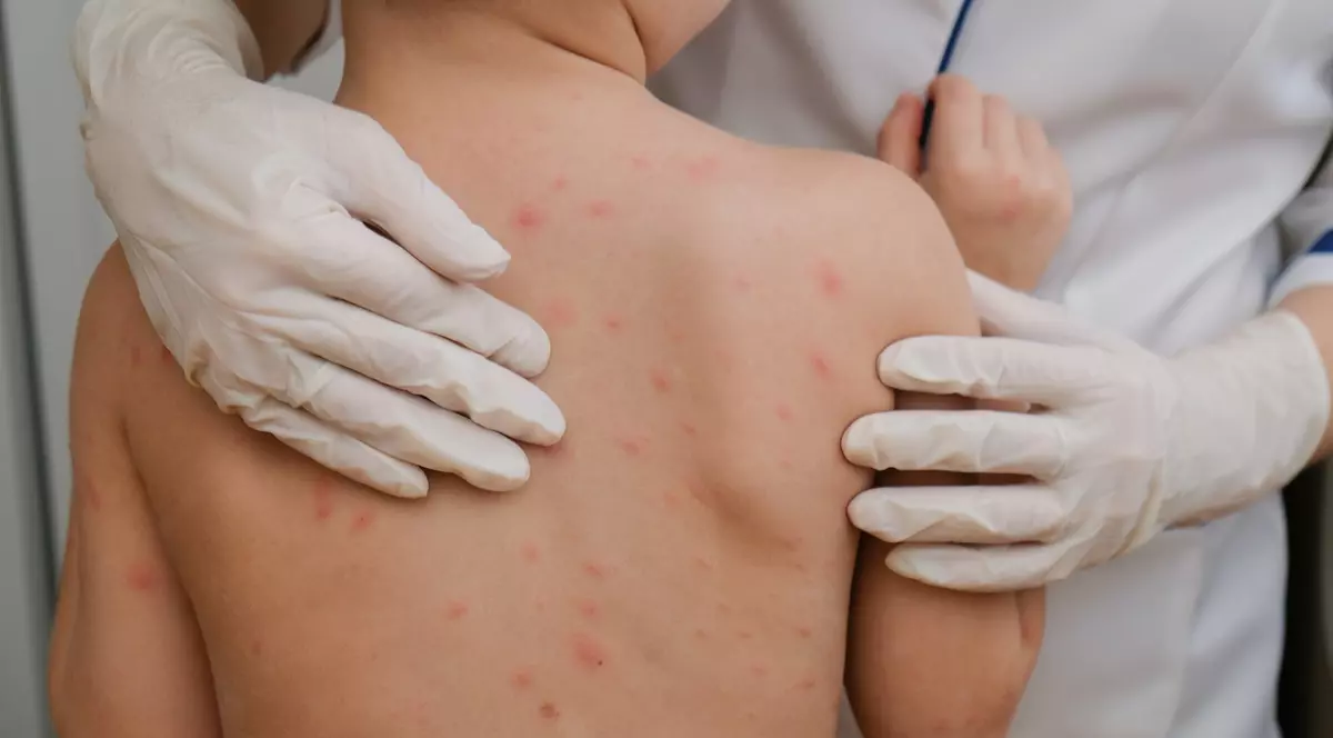 Ministerul Sănătății a declarat epidemie de rujeolă în România. Aproape 2.000 de cazuri înregistrate în 29 de județe