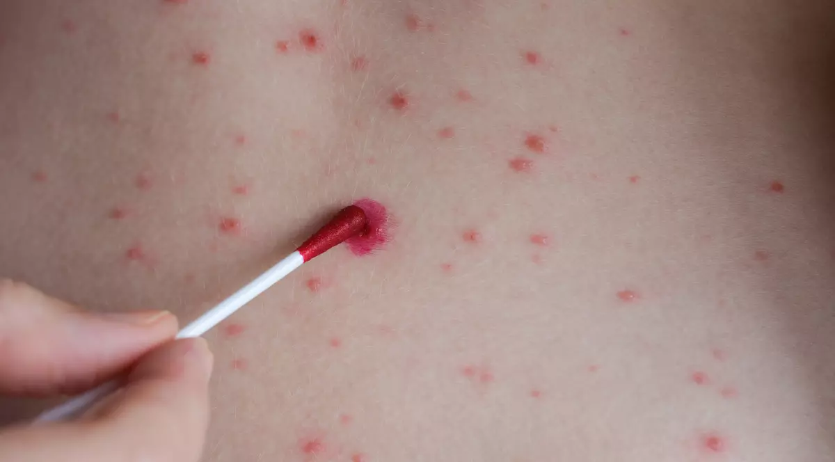 Primul deces de la declararea epidemiei de rujeolă în România: un bebeluș de 7 luni, care a luat boala de la fratele lui nevaccinat