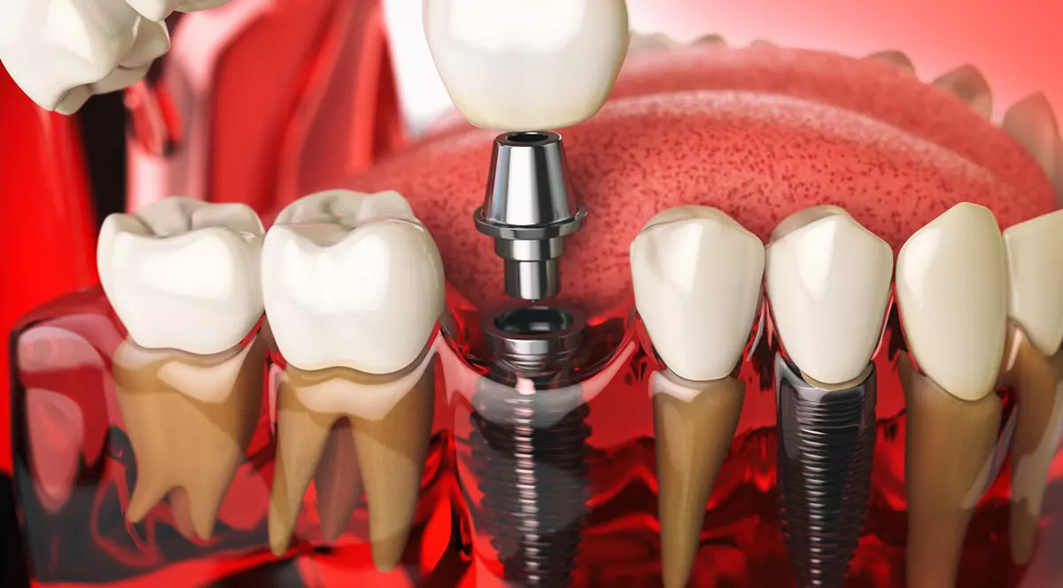 Implanturile dentare: Evoluția și popularitatea lor în restaurarea dentară