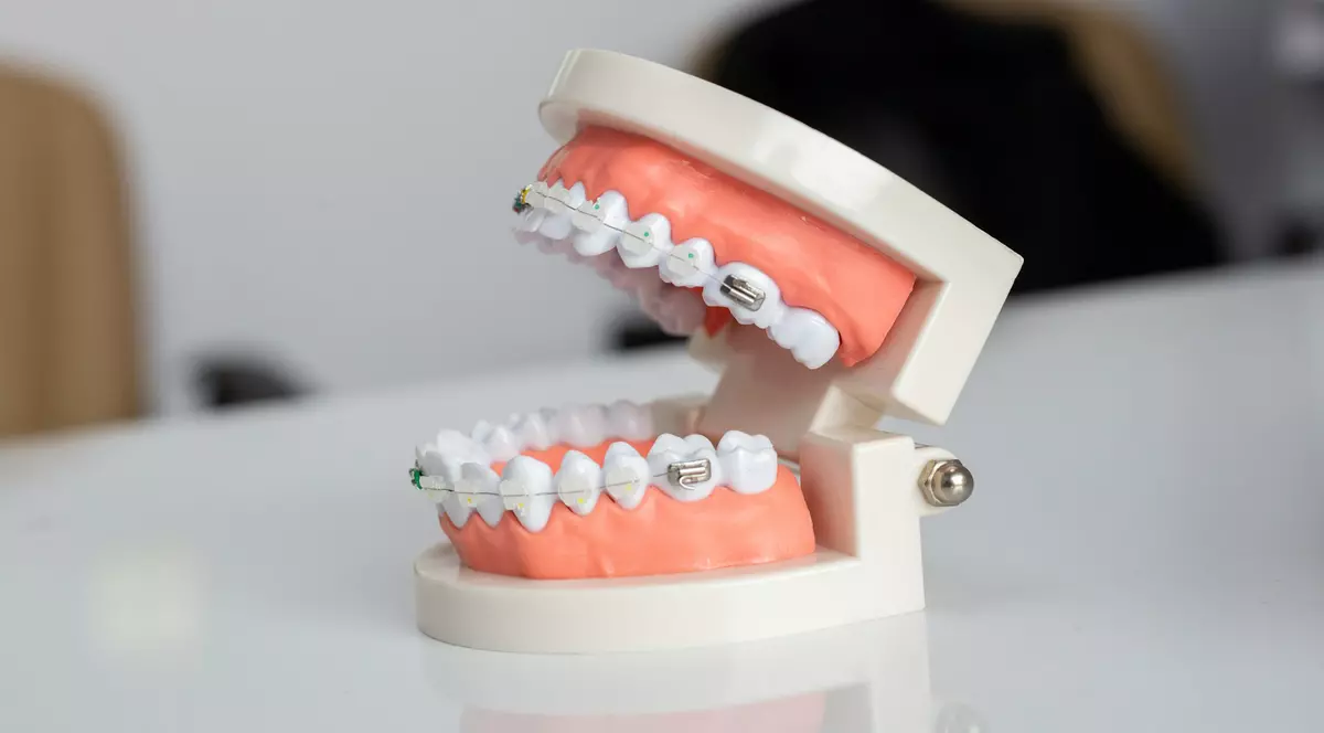 Cât costă un aparat dentar și cum alegi varianta potrivită pentru tine