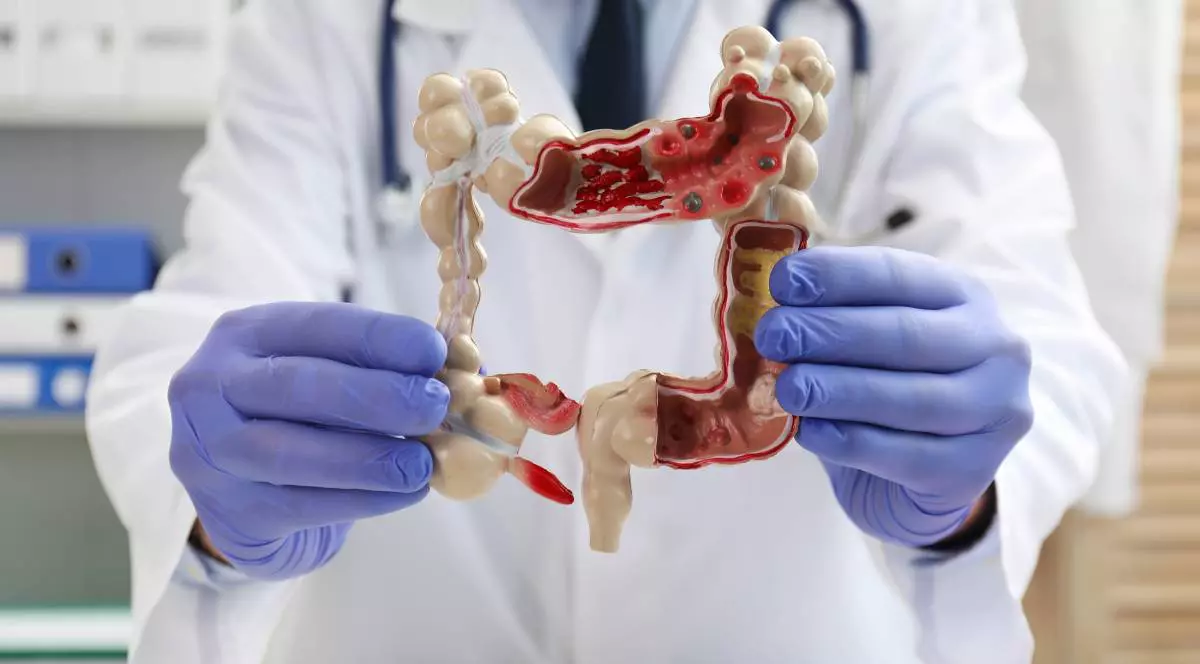 Medic îmbrăcat într-un halat alb, cu un stetoscop la gât și mănuși mov în mâini, ține o machetă de plastic care reprezintă colonul.