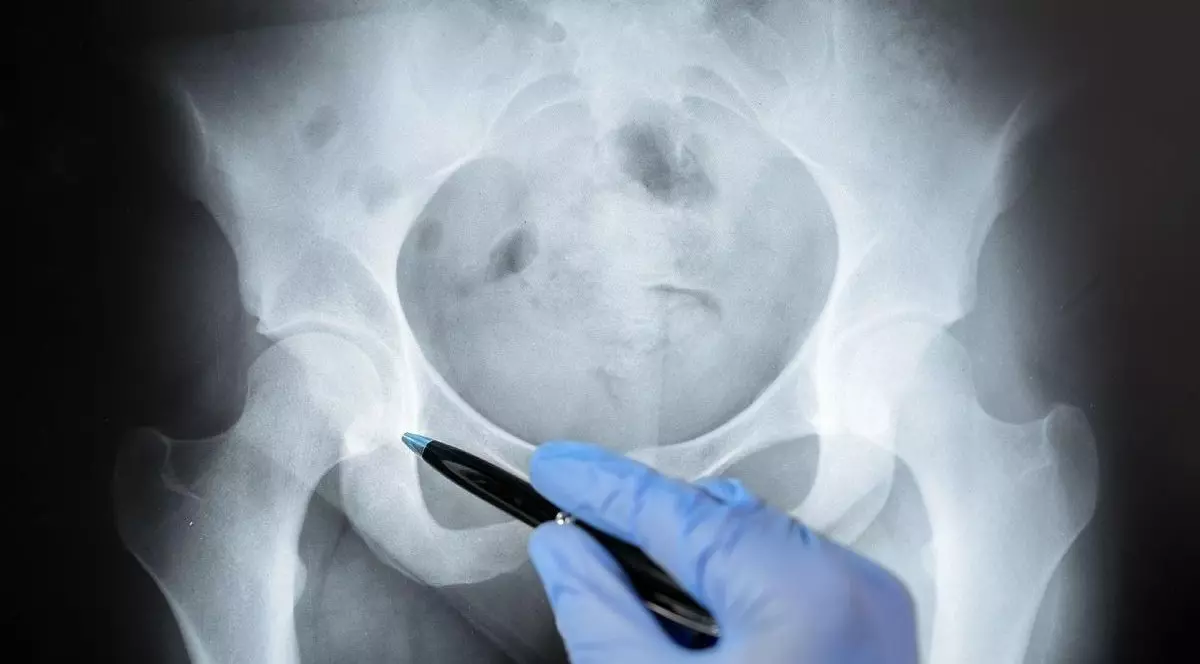 Medic analizează radiologic osul pelvian cu radiografie. Mâna unui medic analizează și indică cu un pix zona afectată.
