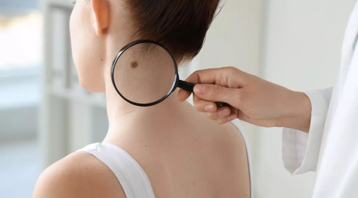 Doctor examinează alunița unei femei cu lupă în clinică, prim-plan