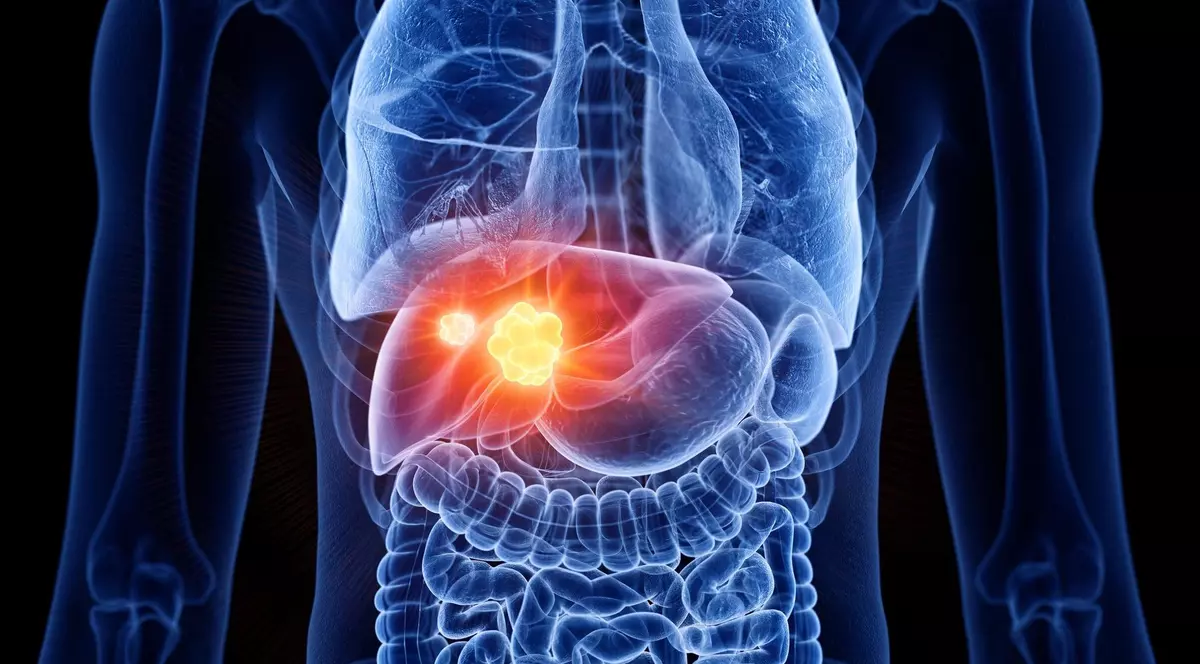 Ilustrație cancer hepatic