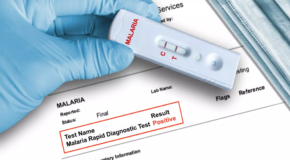 Rezultat pozitiv al testului pentru malarie, indicând prezența paraziților malarici, obținut cu ajutorul unui dispozitiv de diagnostic rapid, ținut în mănușă medicală