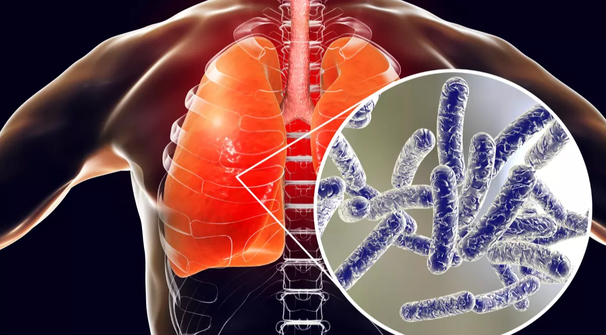 Ilustrație cu plămâni afectați de bacteria