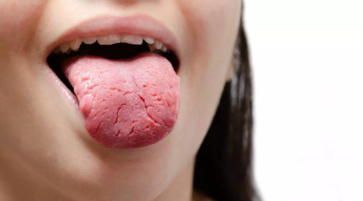 O femeie scoate limba. Ea a fost diagnosticată cu glosită migratoare benignă denumită și limbă geografică