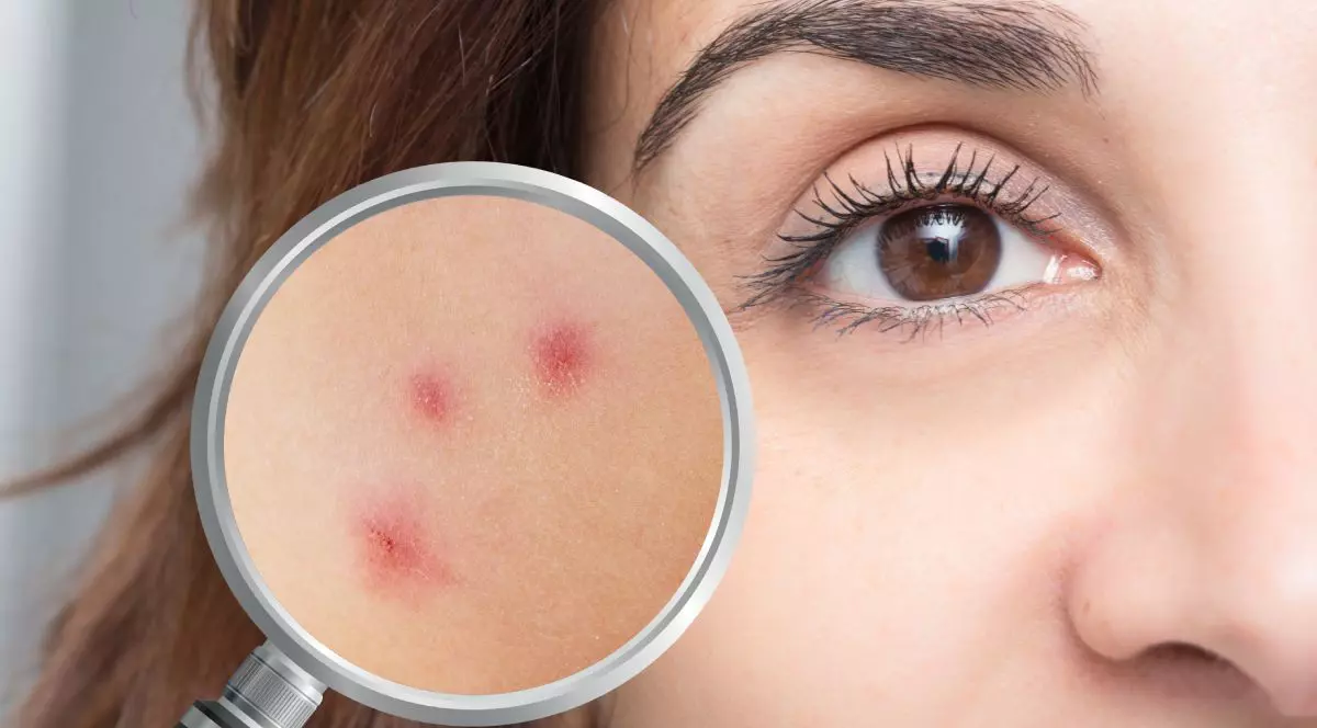 Imagine creativa, o jumatate de fata a unei tinere, si o zona marita cu lupa pe care se vad trei puncte acneice rosii