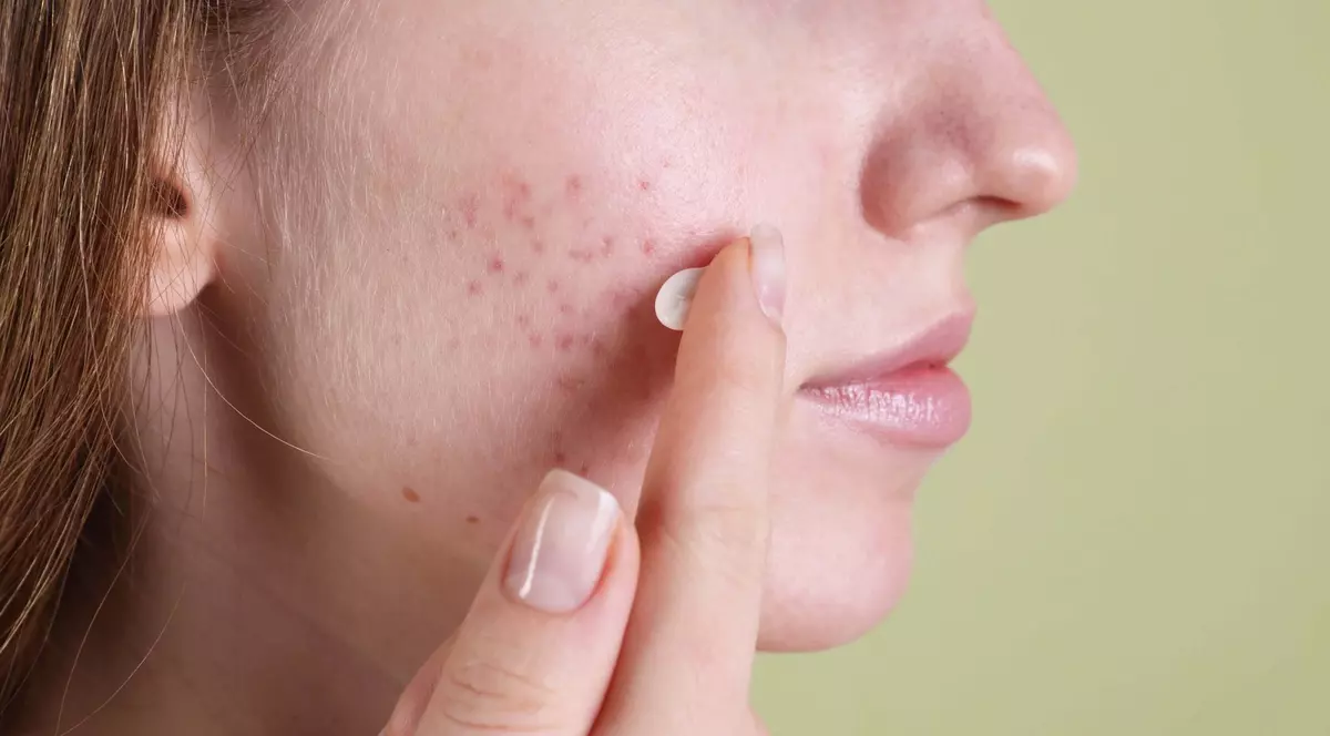Femeie cu ten accneic, aplica crema pe zona afectata