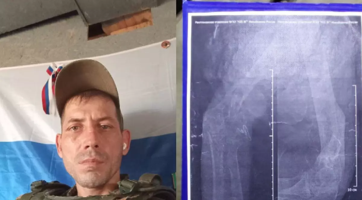 Foștii prizonieri ruși de război răniți sunt trimiși înapoi la luptă: „Am un glonț în mine și mâna fracturată în multe locuri. Suntem schilozi pe frontul din Donețk”