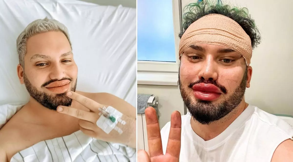 colaj foto format din două imagini: imaginea din stânga arata un bărbat cu p branulă în mână, pe patul de spital, zâmbind iar imaginea din dreapta arată același bărbat, cu bandaje pe cap și cusături în jurul ochilor